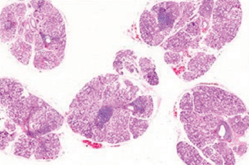 Image: Photomicrograph of a salivary gland with sites of inflammation indicative of Sjögren's syndrome (Photo courtesy of US National Institute of Dental and Craniofacial Research).